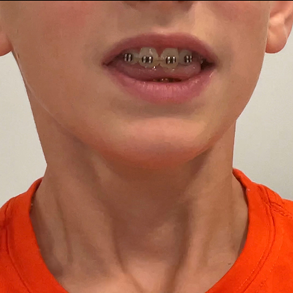 Example of tongue thrust before therapy.