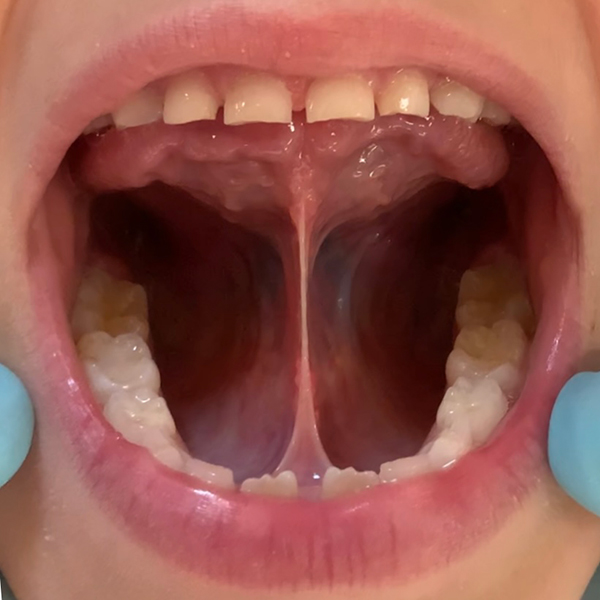 Example of tongue tie